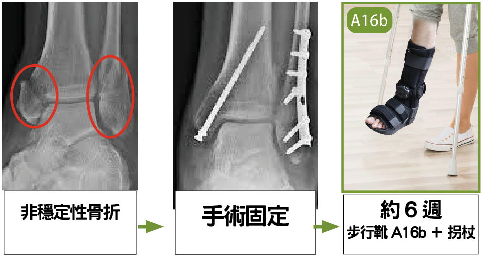 非穩定性足踝骨折手術固定與術後復康流程